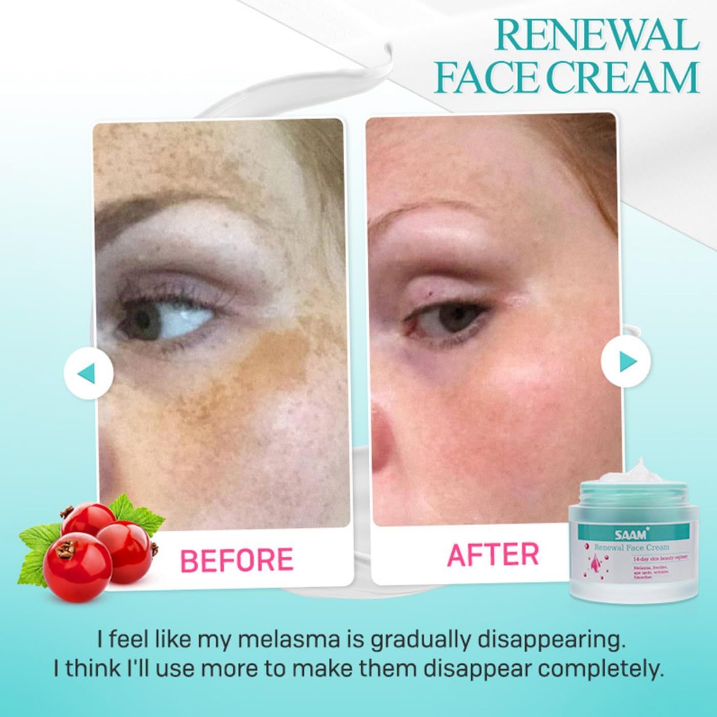 Cream Is Suitable For Chloasma And Freckles